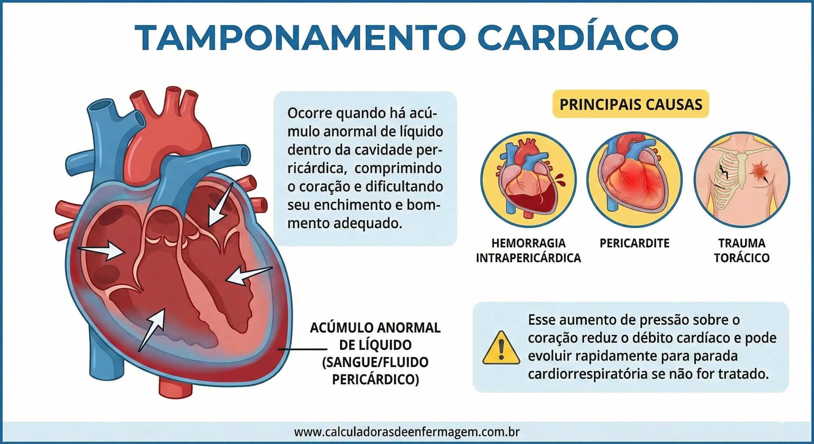 5ts Tamponamento Cardiaco